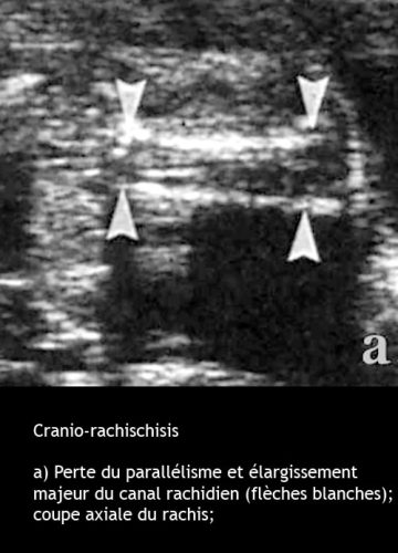 Cranio-rachischisis 1