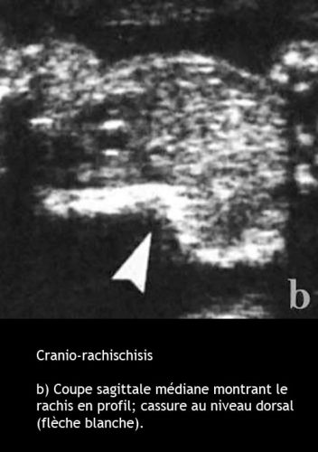 Cranio-rachischisis 2
