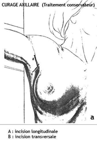 Curage axillaire 1