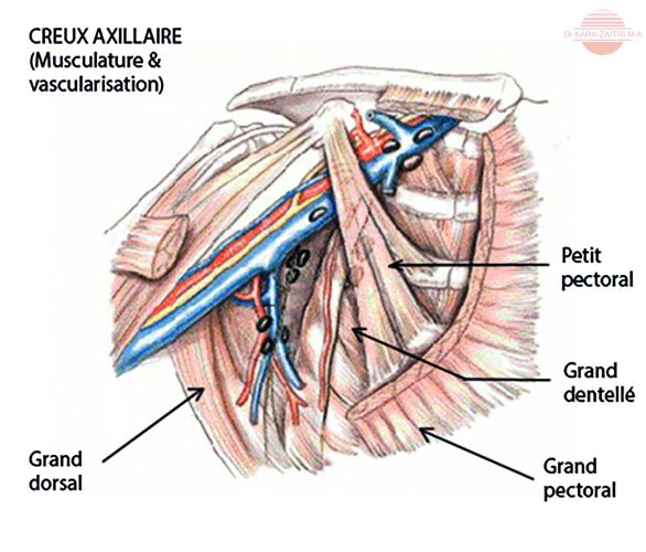 Curage axillaire — technique chirurgicale cancer du sein 1