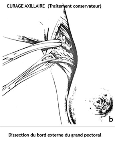 Curage axillaire 2