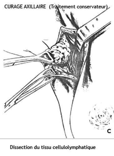 Curage axillaire 3