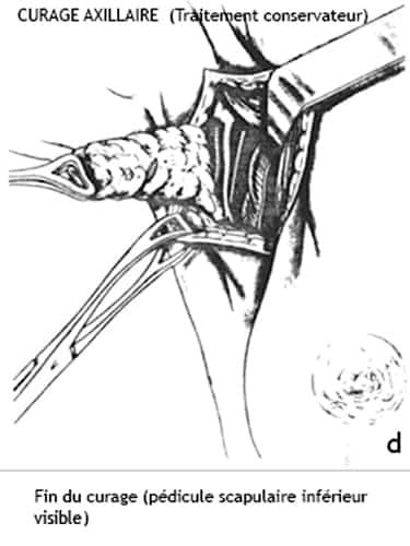 Curage axillaire 4