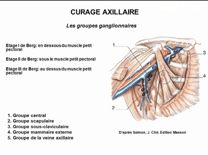 Curage axillaire — technique chirurgicale cancer du sein 3