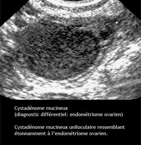 Cystadénome mucineux ovarien — tumeur bénigne mucineuse ovaire