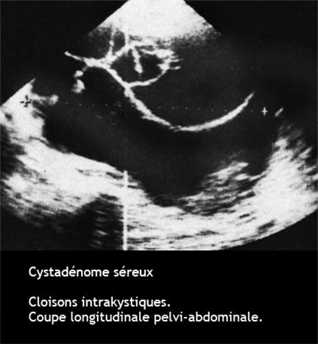 Cystadénome séreux