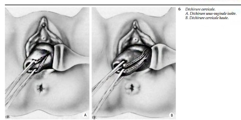 Dechirure cervicale