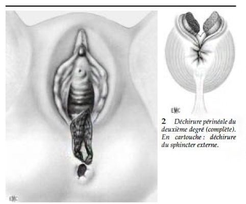 Dechirure perineale 2