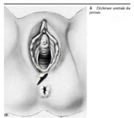 Dechirure perineale 4
