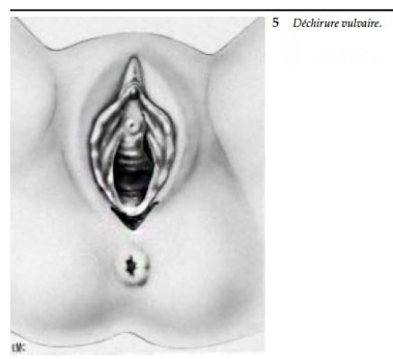 Dechirure perineale 5