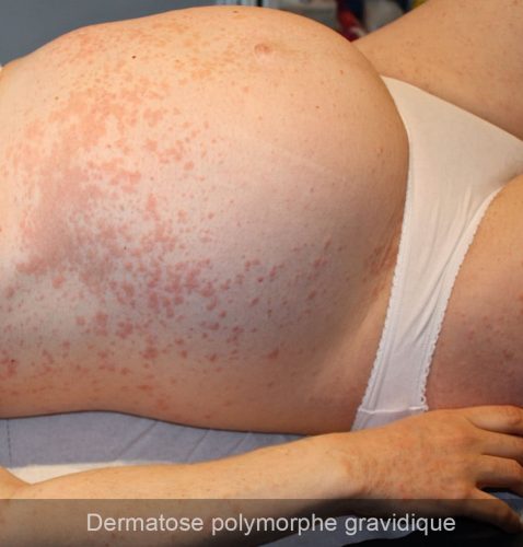Dermatose polymorphe gravidique 1
