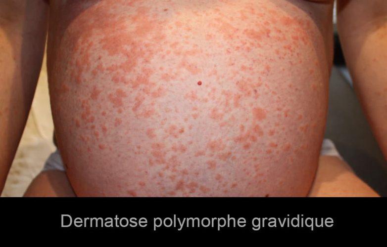 Dermatose polymorphe gravidique 2