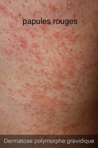 Dermatose polymorphe gravidique 3