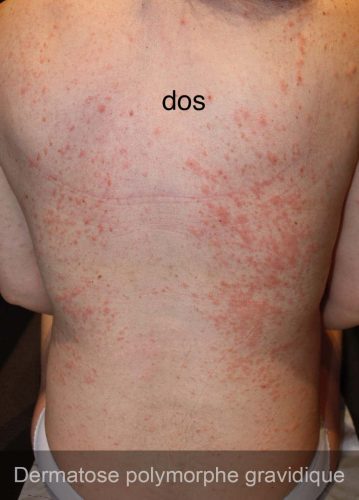 Dermatose polymorphe gravidique — lésions cutanées grossesse 4