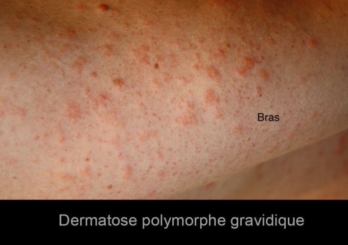 Dermatose polymorphe gravidique — lésions cutanées grossesse 5