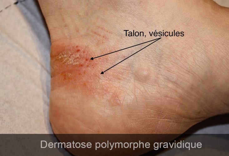 Dermatose polymorphe gravidique — lésions cutanées grossesse 6