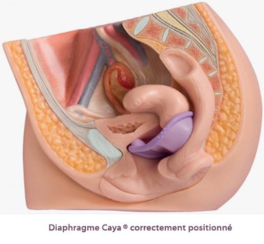 Diaphragme contraceptif — pose et utilisation contraceptif barrière 4