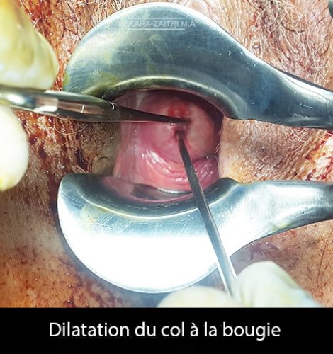 Dilatation du col_bougie