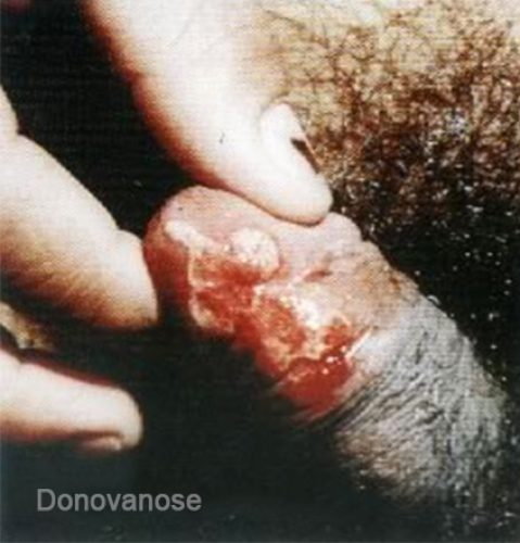 Donovanose 1