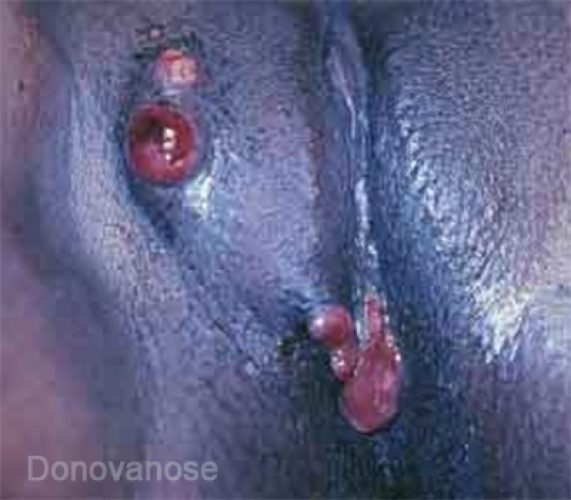 Donovanose 7