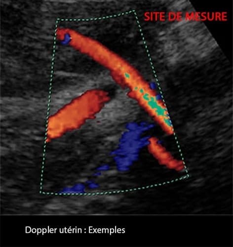 Doppler art_uterine 2