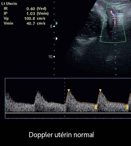 Doppler art_uterine 3