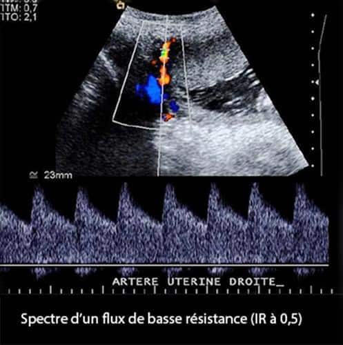 Doppler art_uterine 4