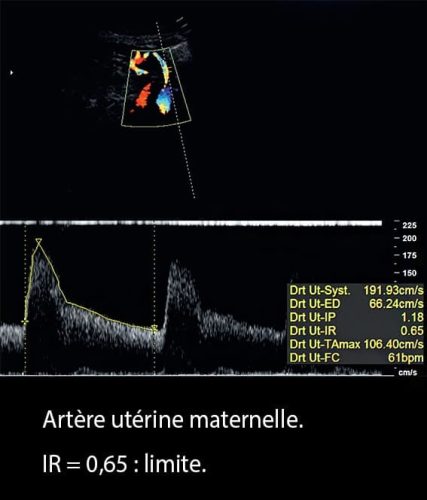 Doppler art_uterine 5