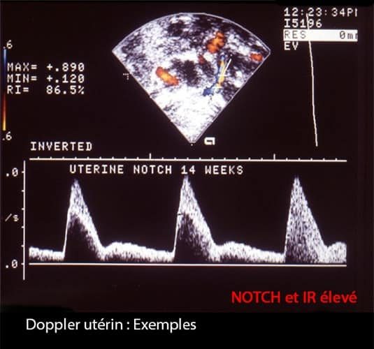 Doppler art_uterine 8
