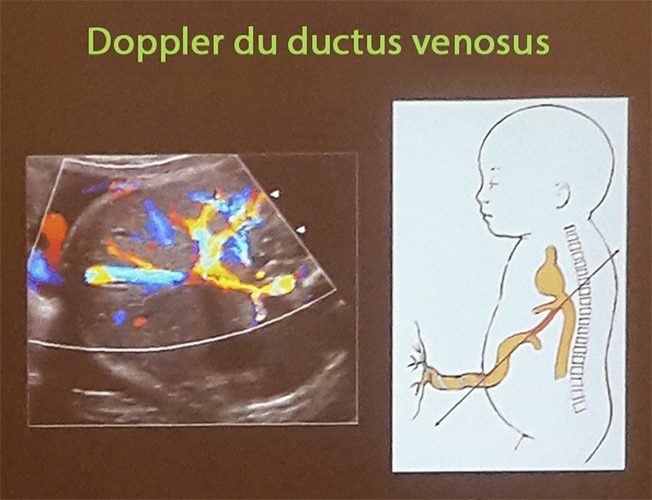 Doppler ductus 1