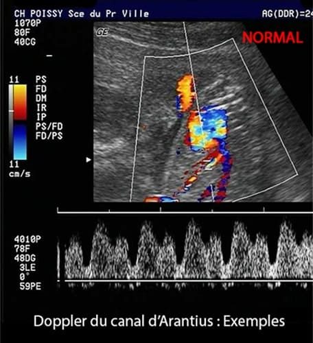 Doppler ductus 10