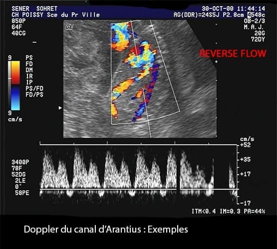 Doppler ductus 11