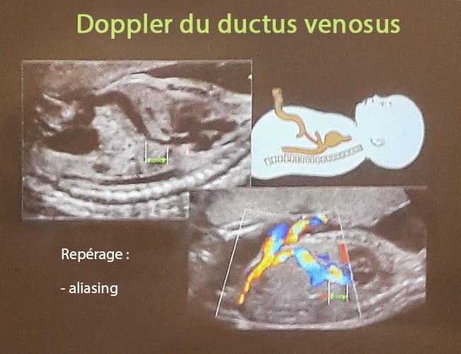 Doppler ductus 12