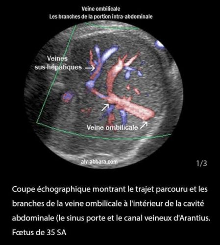 Doppler ductus 2
