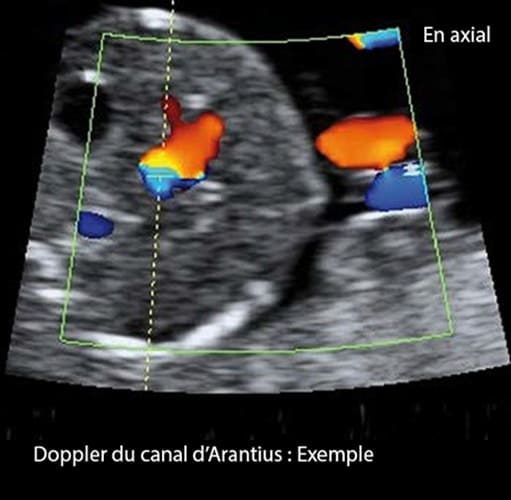 Doppler ductus 5