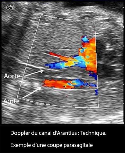 Doppler ductus 6