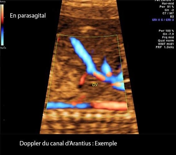 Doppler ductus 7