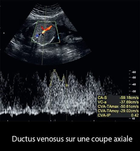 Doppler ductus 8