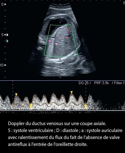 Doppler ductus 9