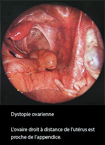 Dystopie ovarienne 1