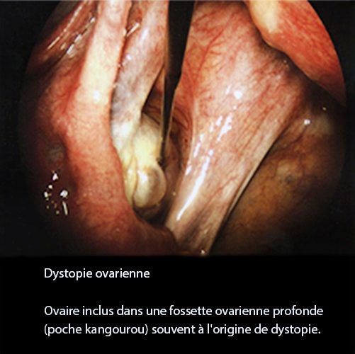 Dystopie ovarienne 3