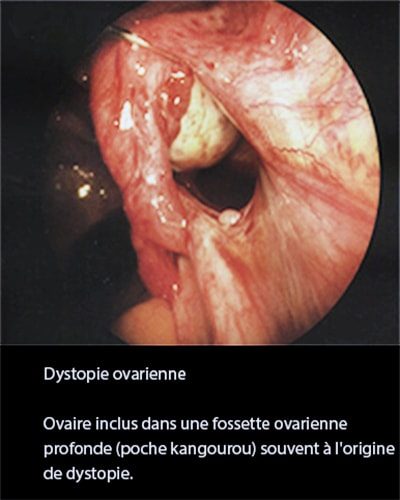 Dystopie ovarienne 4