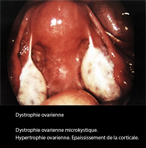 Dystrophie ovarienne 1_coelio