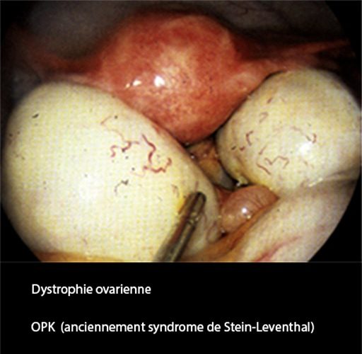 Dystrophie ovarienne 2_coelio