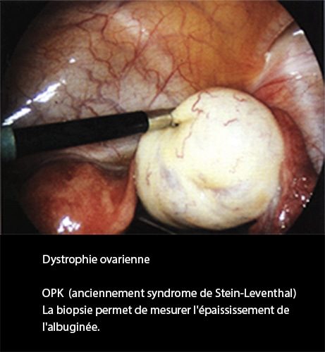 Dystrophie ovarienne 3_coelio