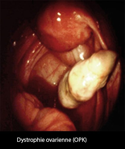 Dystrophie ovarienne 4_coelio