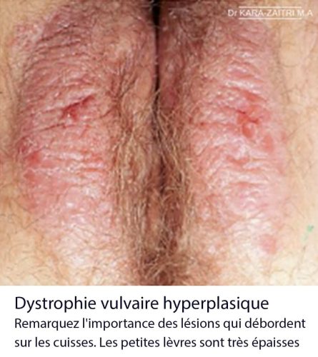 lésions blanches de la vulve. Dystrophie vulvaire hyperplasique — lésion vulvaire chronique