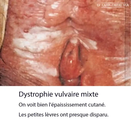 lésions blanches de la vulve. Dystrophie vulvaire mixte — aspect clinique