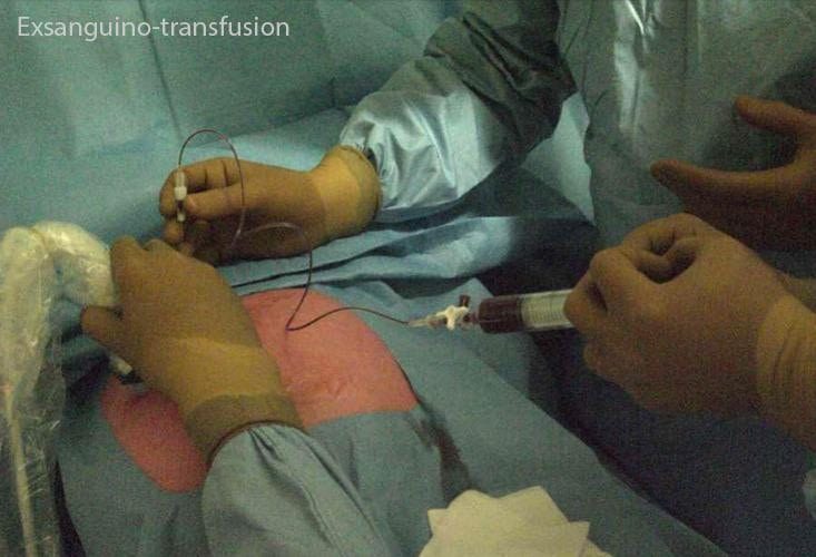 Électrostimulation transcutanée 1 — analgésie obstétricale TENS