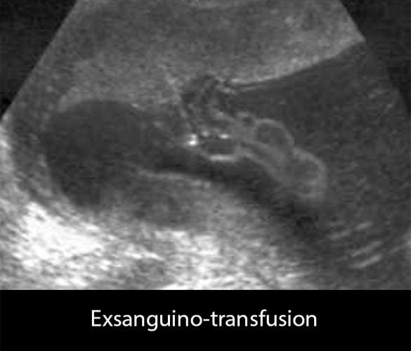 Électrostimulation transcutanée 2 — analgésie obstétricale TENS